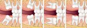 Which Wisdom Tooth Hurts the Most