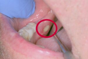 White Spot on Gum Where Wisdom Tooth was