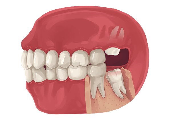 why-is-my-tongue-swollen-after-wisdom-tooth-extraction