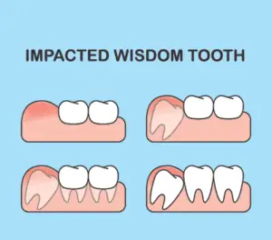 Will a Dentist Fill a Wisdom Tooth