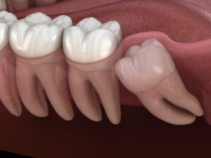 Wisdom Tooth Pain When Lying down