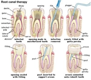 Wisdom Tooth Root Canal Problems