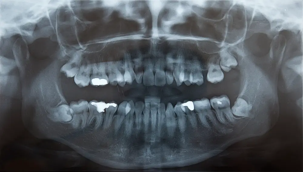 can-i-take-ibuprofen-before-wisdom-tooth-extraction