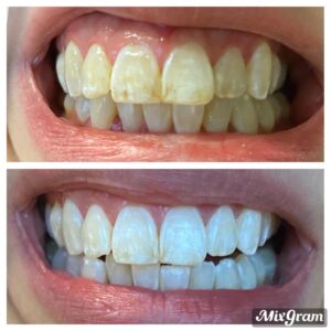 Can I Use Toothpaste After Wisdom Tooth Extraction Reddit