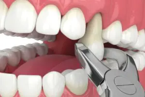 Can I Use Toothpaste After Wisdom Tooth Extraction