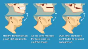 Can Wisdom Tooth Removal Cause Nerve Damage