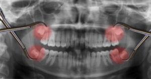 Can You Live With an Impacted Wisdom Tooth