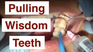Can a Dentist Pull a Broken Wisdom Tooth