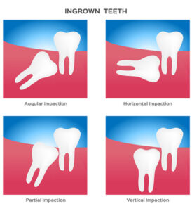 Can a Wisdom Tooth Be Pulled Without Surgery