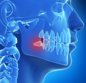 Can a Wisdom Tooth Cause Migraines