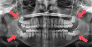 Can an Impacted Wisdom Tooth Fix Itself