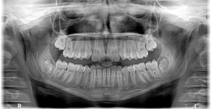 Can’T Open Mouth Wisdom Tooth