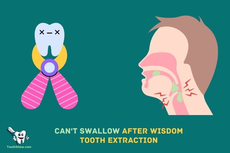 Can t Swallow After Wisdom Tooth Extraction