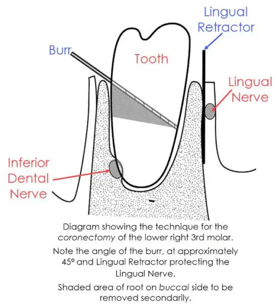 why-is-my-tongue-numb-after-wisdom-tooth-extraction