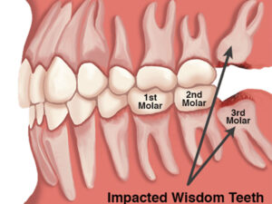 Difference between Molar And Wisdom Tooth