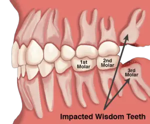 Does Wisdom Tooth Hurt When Growing