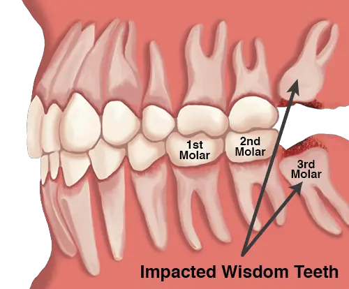 does-wisdom-tooth-hurt-when-growing