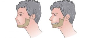 Does Wisdom Tooth Removal Change Face Shape