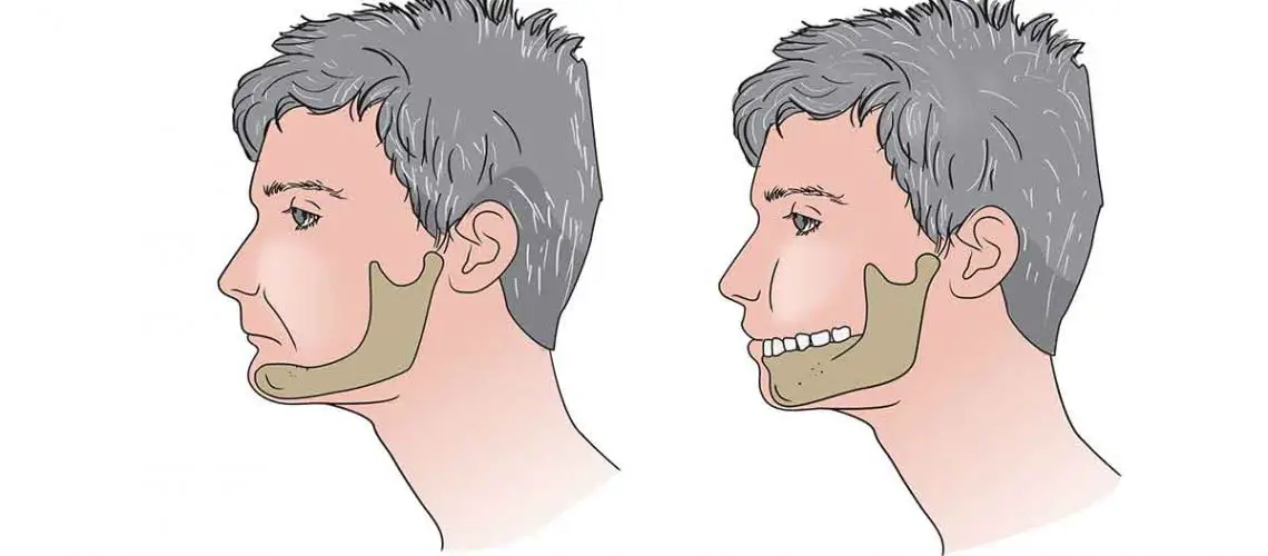 does-wisdom-tooth-removal-change-face-shape