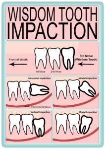 Erupted Wisdom Tooth Vs Impacted