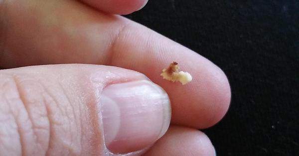 Gum Hurts Where Wisdom Tooth Was Removed Years Ago Reddit