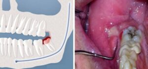 Gum Hurts Where Wisdom Tooth was Removed