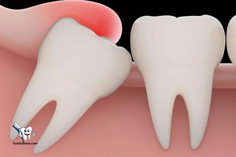 How Long Does Wisdom Tooth Pain Last Reddit