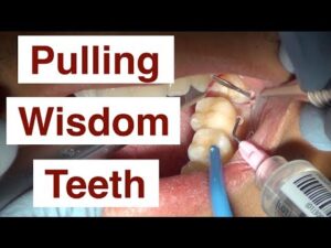 How Much is Emergency Wisdom Tooth Removal