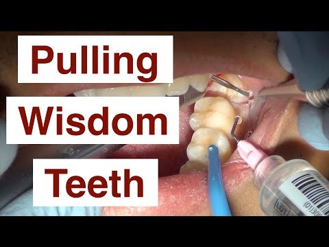 How Much Is Emergency Wisdom Tooth Removal