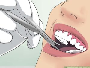 How to Clean Wisdom Tooth