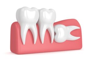 How to Ease Wisdom Tooth Pain before Surgery