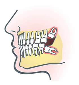 How to Know If Wisdom Tooth Needs to Be Removed