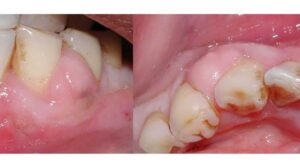 How to Know If You Have an Abscess Wisdom Tooth