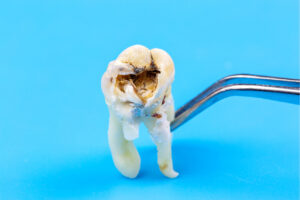How to Stop Broken Wisdom Tooth Pain