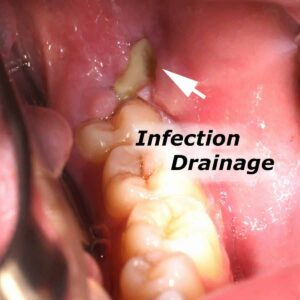 Infection Where Wisdom Tooth Used to Be