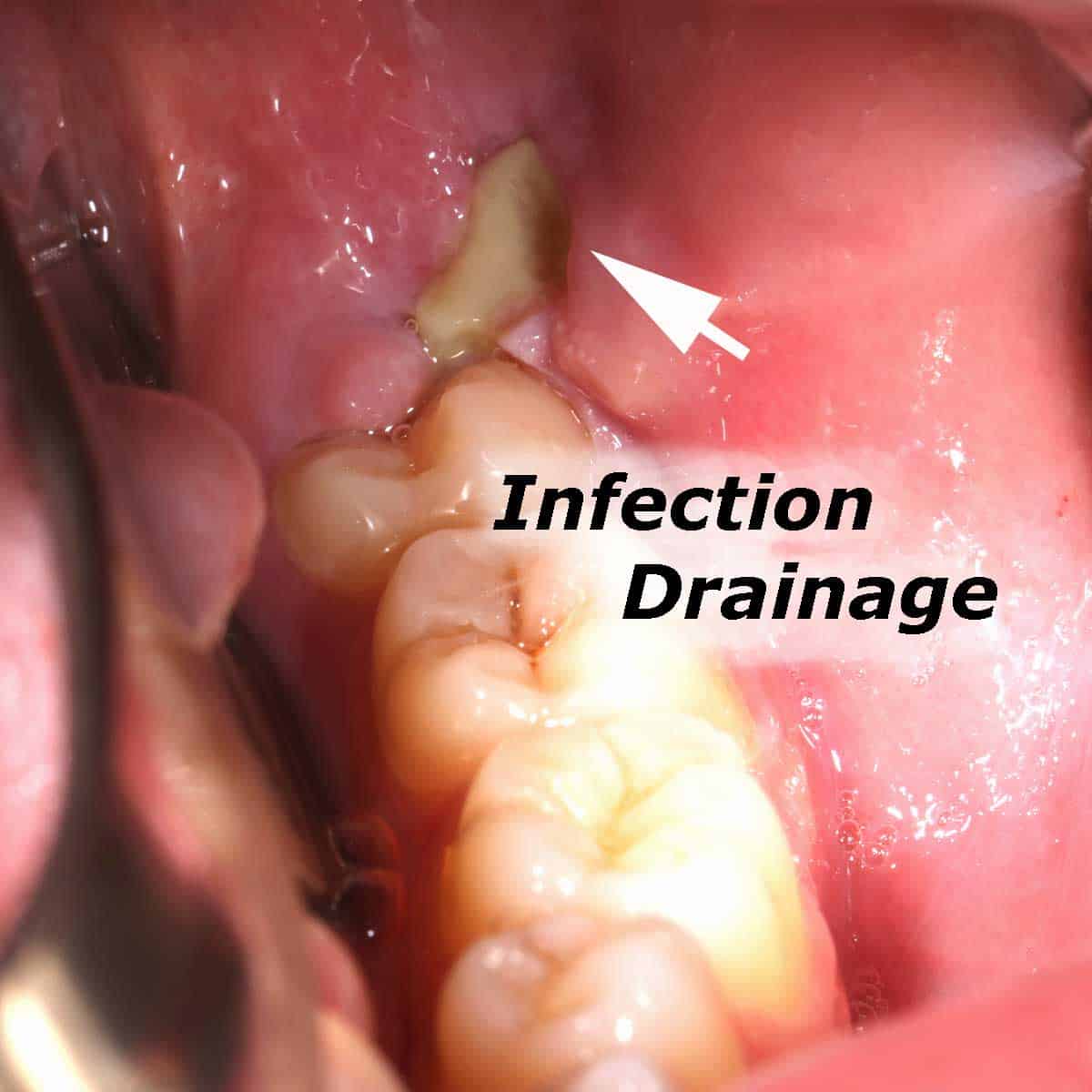 infection-where-wisdom-tooth-used-to-be