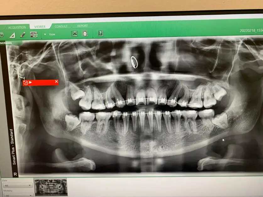 is-bone-graft-necessary-after-wisdom-tooth-extraction-reddit