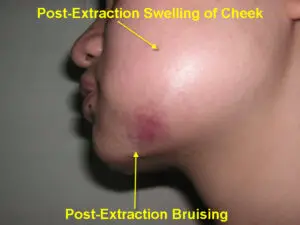 Is Bruising Normal After Wisdom Tooth Extraction