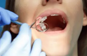 Is It Ok to Talk After Wisdom Tooth Extraction