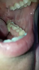 Is Pus Normal After Wisdom Tooth Extraction