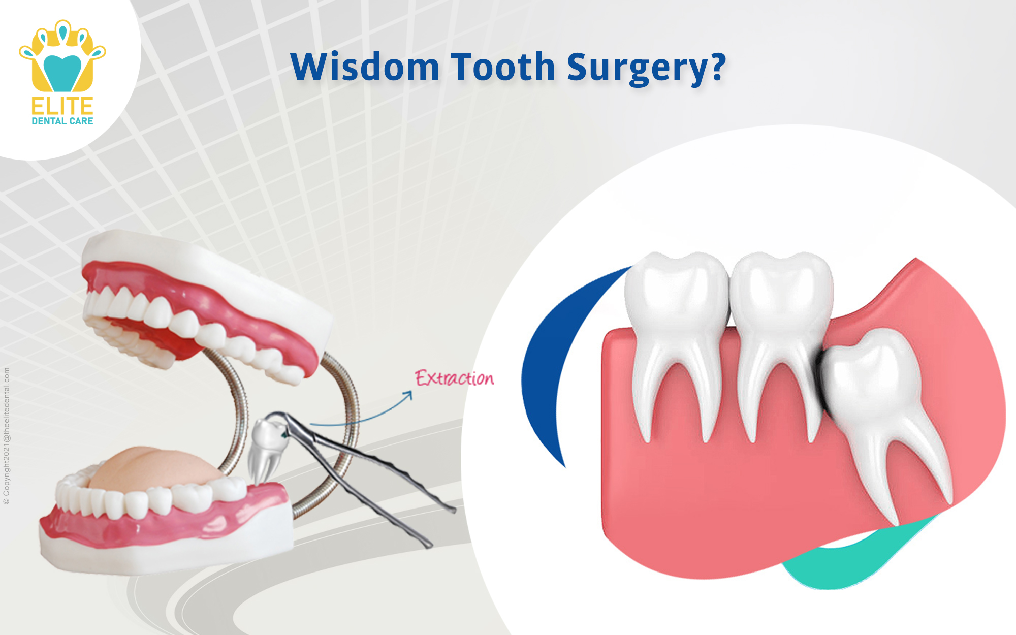 is-wisdom-tooth-removal-considered-surgery