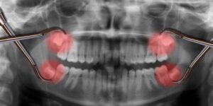Is Wisdom Tooth Removal Free