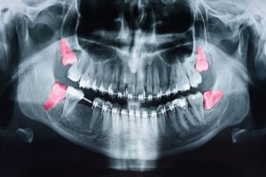 Is Wisdom Tooth Removal Orthodontic