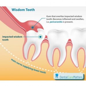 Is a Partially Erupted Wisdom Tooth Bad