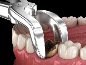 Is a Wisdom Tooth a Simple Extraction