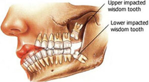 Molar And Wisdom Tooth Difference