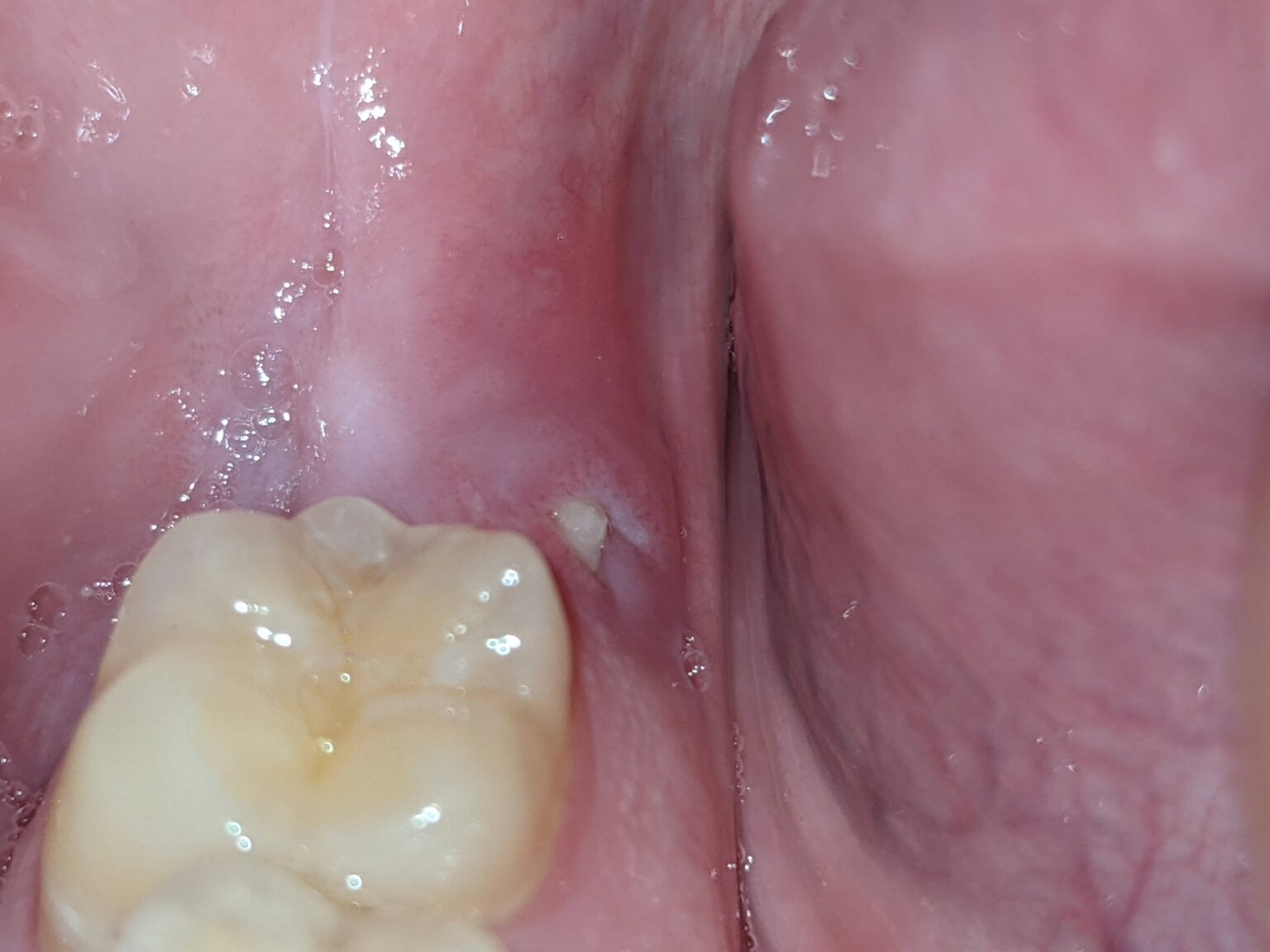 Pain Where Wisdom Tooth Was Removed Months Later