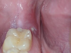 Pain Where Wisdom Tooth was Removed Years Ago