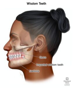 Spot Where Wisdom Tooth was Removed Hurts