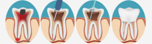 Surgical Vs Non Surgical Wisdom Tooth Extraction